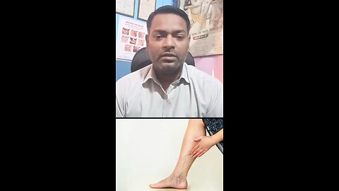 Varicose veins (वैरिकोज़ वेन्स) का इलाज ।
