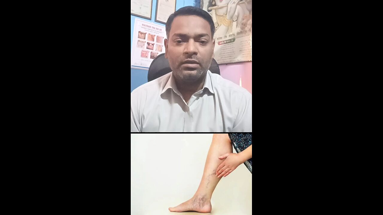 Varicose veins (वैरिकोज़ वेन्स) का इलाज ।