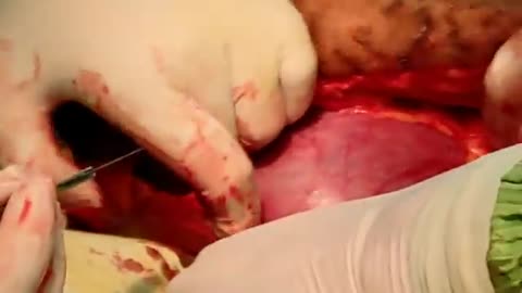 C-Section of baby delivery