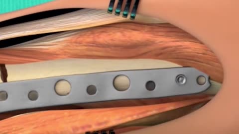 Here Is How I Recovered From Bus Accident!