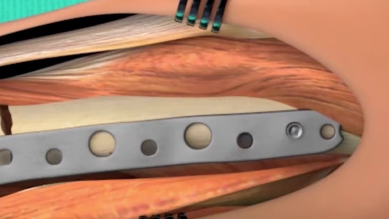 Here Is How I Recovered From Bus Accident!