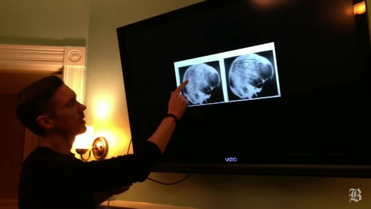 Forensic Pathologist compares Rear Headshot on JFK Autopsy/Warren Comm Rpt vs HSCA Report(higher up)