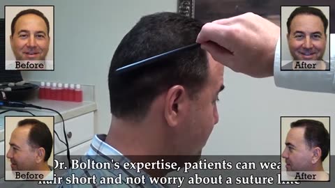 Dr. Brett Bolton: Flawless Hair Restoration Suture Line