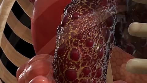 Kidney Miracle: Universal Type O!