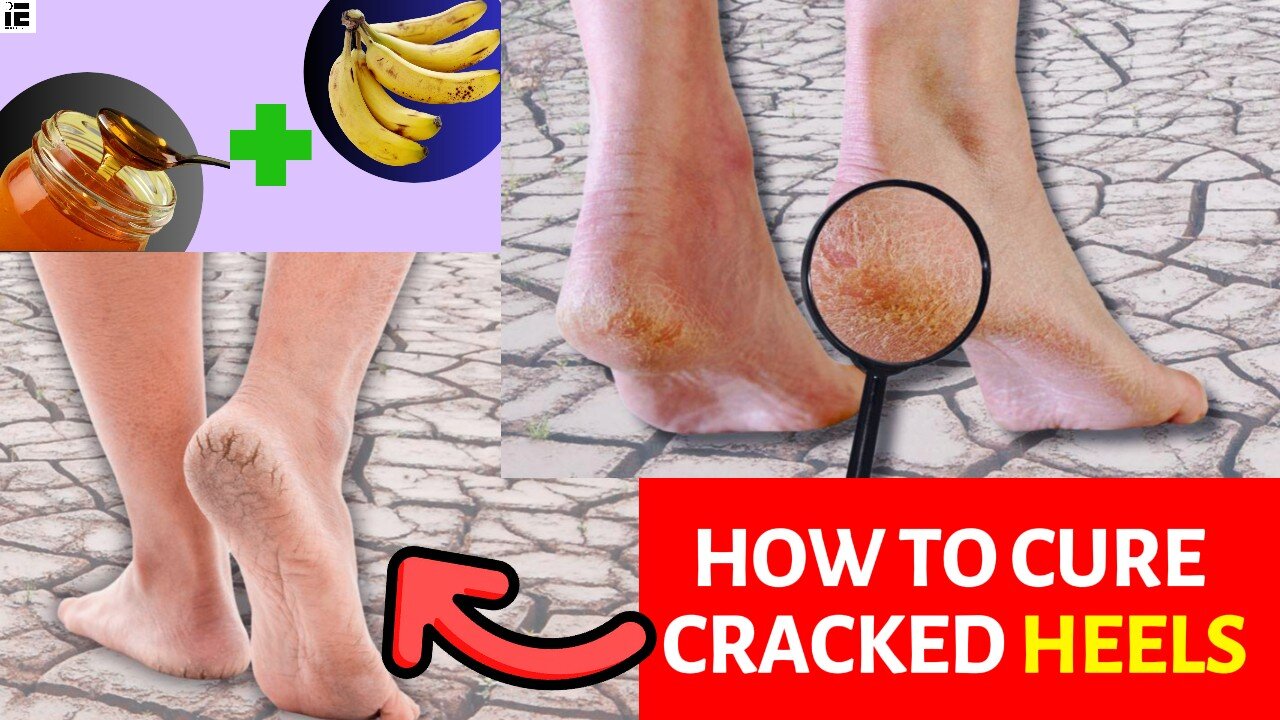 Get Rid of Cracked Heels FAST with This Simple Home-made Remedy!