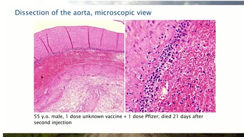 Aortic Dissection Caused By Covid Vaccine: Pathologist Arne Burkhardt (01)