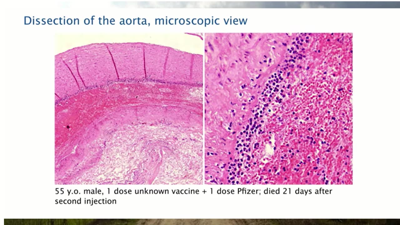 Aortic Dissection Caused By Covid Vaccine: Pathologist Arne Burkhardt (01)