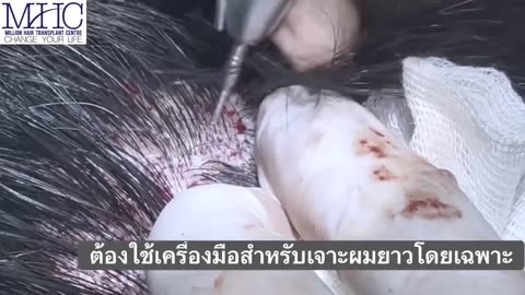 คลินิกปลูกผม MHC ปลูกผม ด้วยวิธี FUE FUT โดยแพทย์ผู้ชำนาญการ ปลูกผม