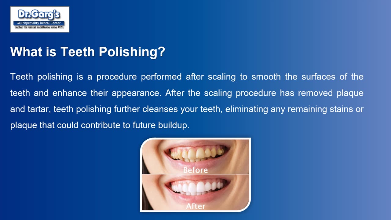 Teeth Scaling and Polishing: The hack for white and healthy teeth!