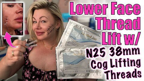 Lower Face Thread Lift with N25 38mm Cog threads! AceCosm.com and code Jessica10 Saves you money