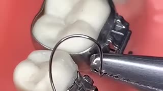 Breaking: BRACES , ORTHODONTICS