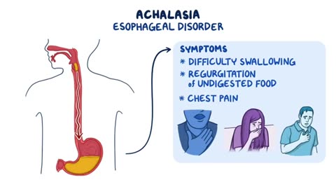 Achalasia (Year of the Zebra)