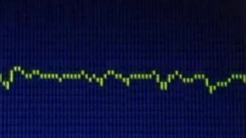 ECG Importance