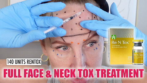 140 Units of Rentox - Full Face + Jowls + Neck #facialrejuvenation #diyskincare