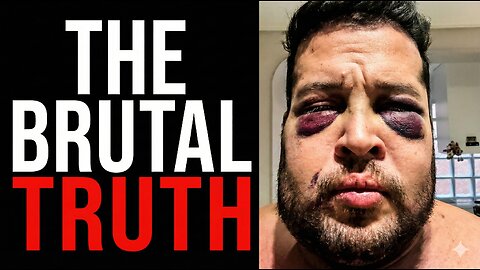 The Brutal Truth About Looksmaxxing (My Surgery Nightmare)| IWAM Ep. 909