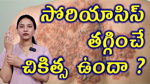 సోరియాసిస్ తగ్గించే చికిత్స ఉందా ? Treatment for Psoroasis Homeopathy Treatment Cure Medicine