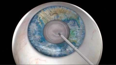 Cataract Surgery ( 3D Animation )