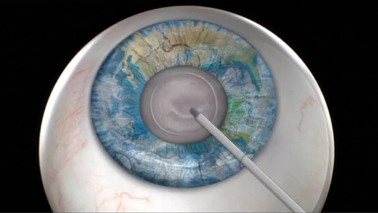 Cataract Surgery ( 3D Animation )