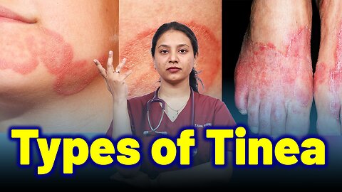 Types of Tinea | Treatment and Cure | Homeopathy, Medicine & Surgery