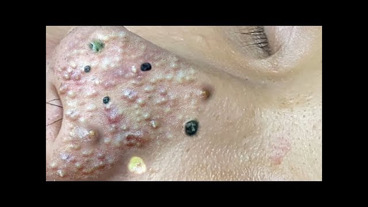 Intense Blackhead Extraction ASMR - Deep Pore Cleansing Facial