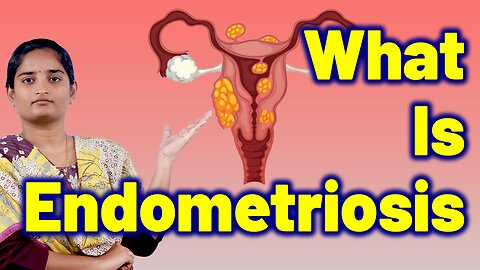 What Is Endometriosis | Female Reproductive Disorder, Pelvic Pain | Homeopathy, Medicine and Cure
