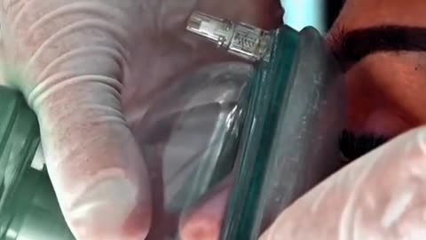 EET Intubation Endotracheal Tube Insertion Explained
