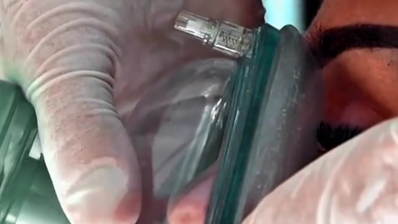 EET Intubation Endotracheal Tube Insertion Explained