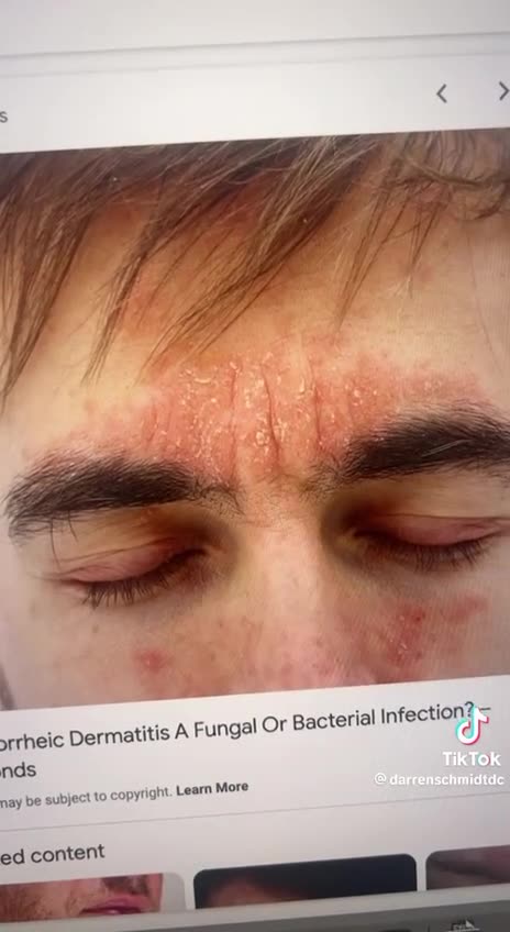 Parasites the cause of everything !!