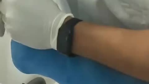 Metatarsal Repair Surgery Foot Fracture Fixation