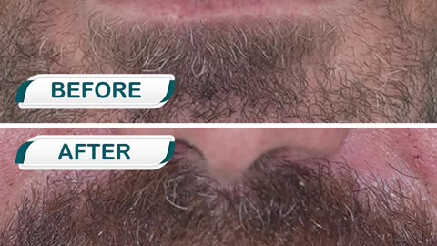 At LHC Clinic, we successfully finished his Hollywood Smile dental treatment.