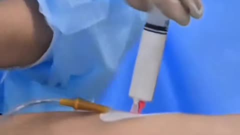 Bariatric Balloon Procedure for Weight Loss Non-Surgical Treatment Explained