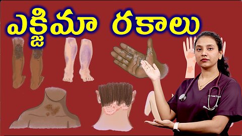 ఎక్జిమా లో రకాలు ఏంటి? Types of Eczema Treatment Cure Medicine | హోమియోపతి