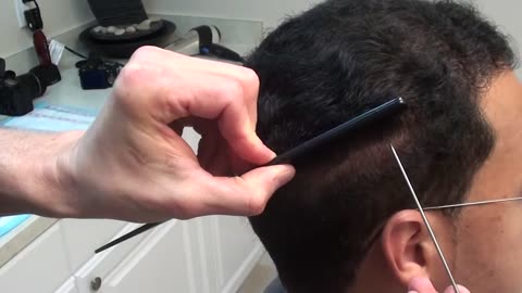 Incredible Undetectable Hair Transplant Scar by Dr. Brett Bolton