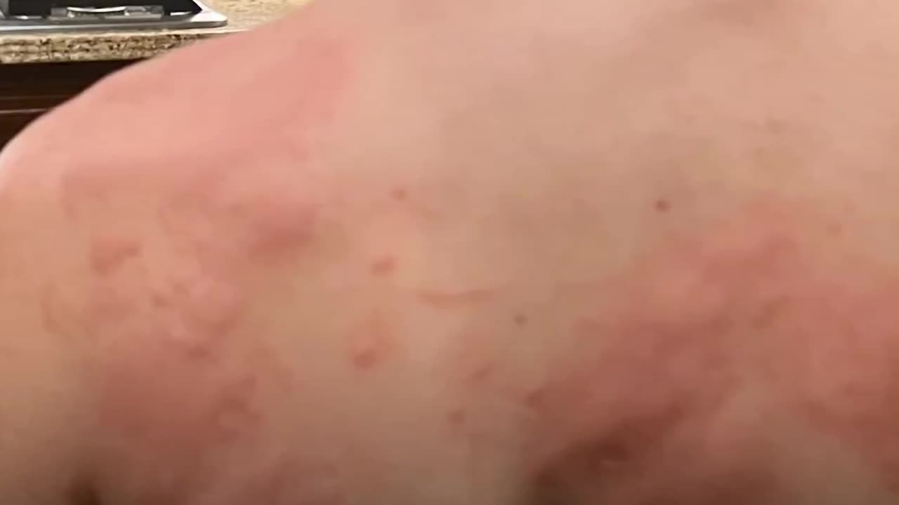 הרופאה מארי טאלי בודן מעידה על פגיעות מחיסונים שראתה בקליניקה שלה ועל ילד בן 15 עם פריחה שנעלמה תוך 3 ימים אחרי טיפול באייברמקטין