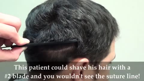 Hair Transplant Scar Correction – Dr. Brett Bolton