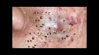 Satisfying blackhead removal, relaxing Pimple Popper spa 33