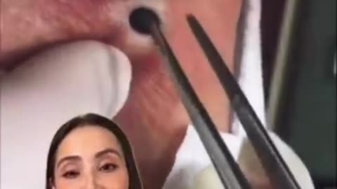 Shocking: Duet with Dr. Pimple Popper: Blackhead extraction