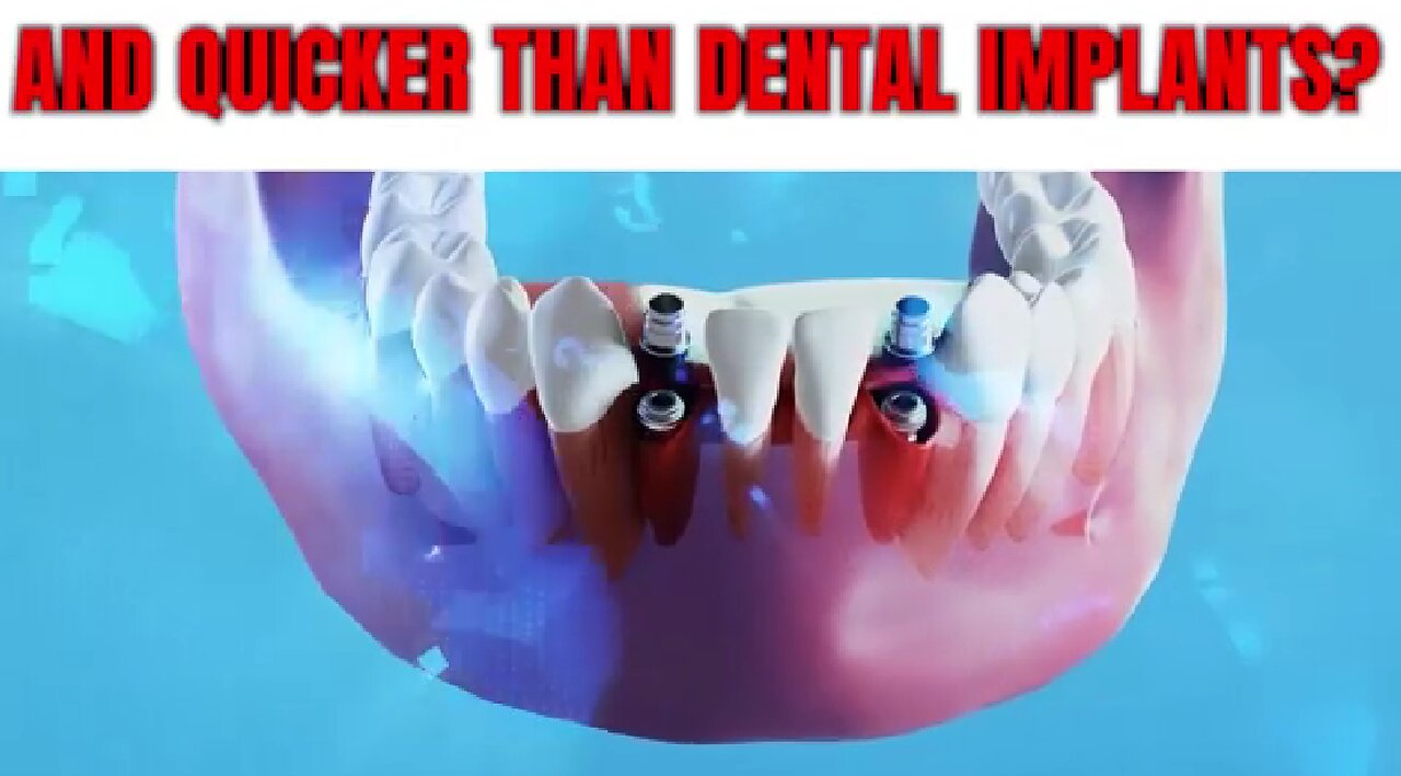 Fix Your Teeth Faster And Quicker Than Dental Implants