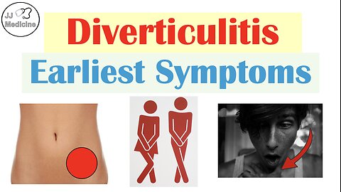 The 5 Early Symptoms of Diverticulitis and an Acute Diverticulitis Flare