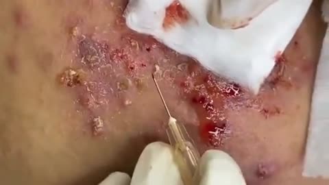 Relax with Satisfying! ASMR blackheads and cystic acne treatment 2022#acne #blackheads #pimple 2022