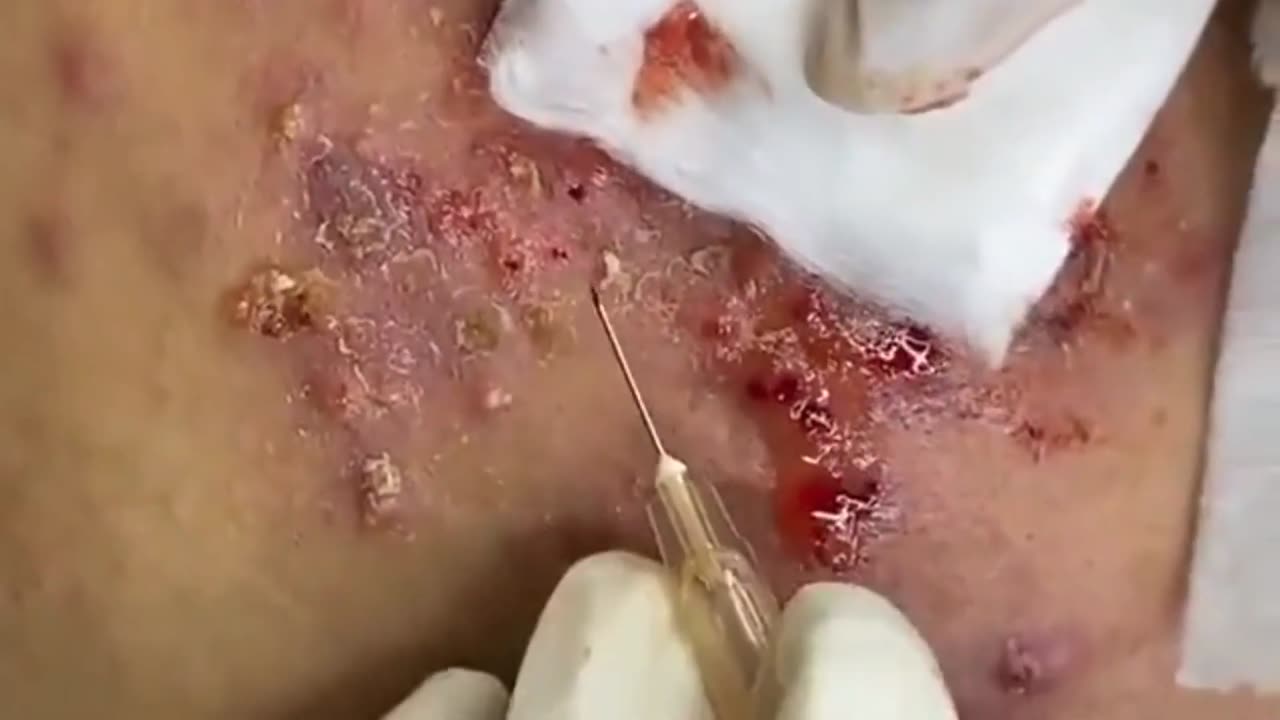 Relax with Satisfying! ASMR blackheads and cystic acne treatment 2022#acne #blackheads #pimple 2022