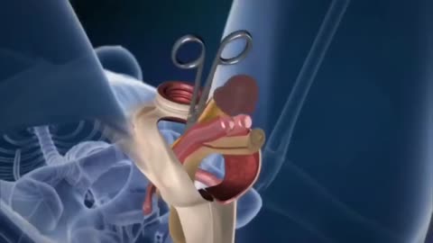 The Hidden Truth Behind Gender Transformation Surgery | 3D Medical Animation Explained