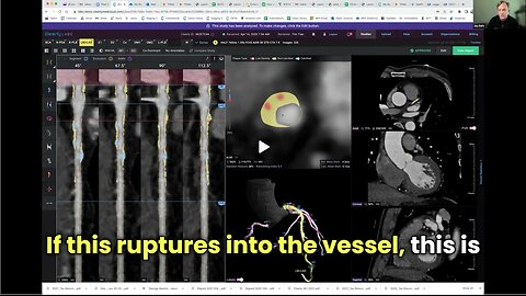The Future of Heart Health: Dr. James Earls on Early Detection (Part 2)