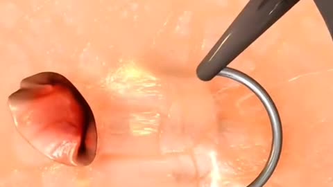 Bladder Tumor Removed Without a Single Cut Here’s How This Surgery Works!