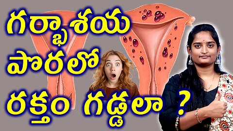 గర్భాశయ పొరలో రక్తం గడ్డలా Clot-Like Formation In Adenomyosis Explained Homeopathy Treatment Cure