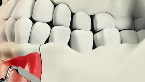 Mandible Repair Surgery Broken Jaw Bone Fix Medical Education