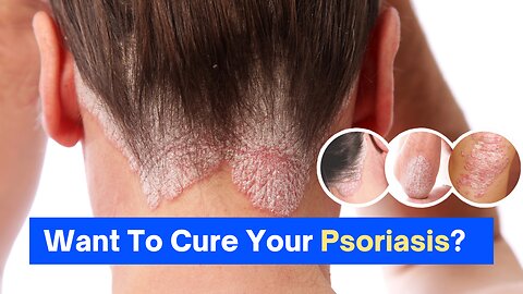 How To Cure Psoriasis