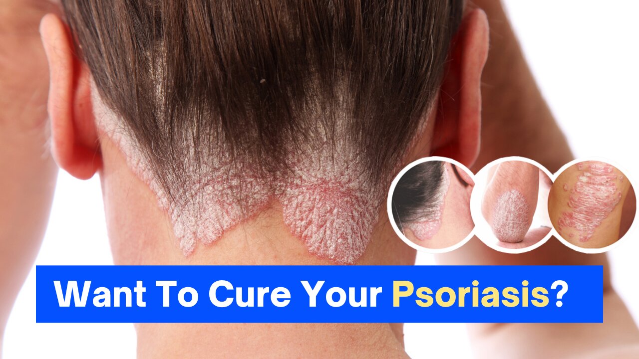 How To Cure Psoriasis