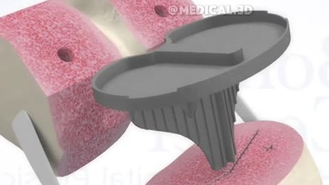 Total Knee Replacement Surgery (3D Animation)