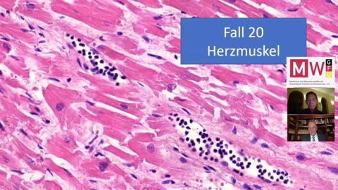 Prof. Arne Burkhardt: Covid-19 “vaccines” can induce self-destruction